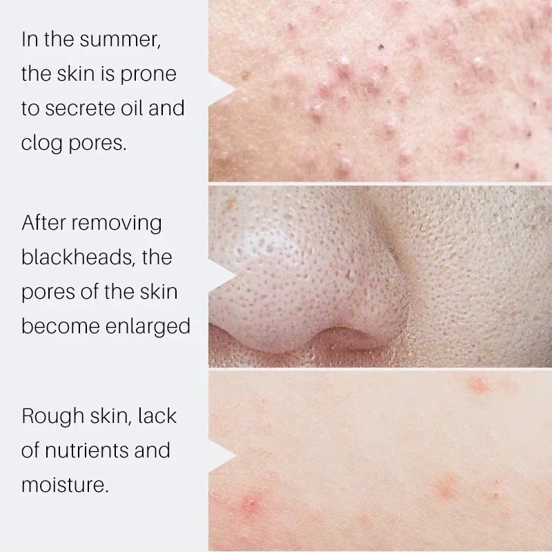 サリチル酸毛穴縮小セラム　即効性で大きな毛穴を解消　黒ずみ・ - Salicylic Acid Blackhead Remover のレビューと価格