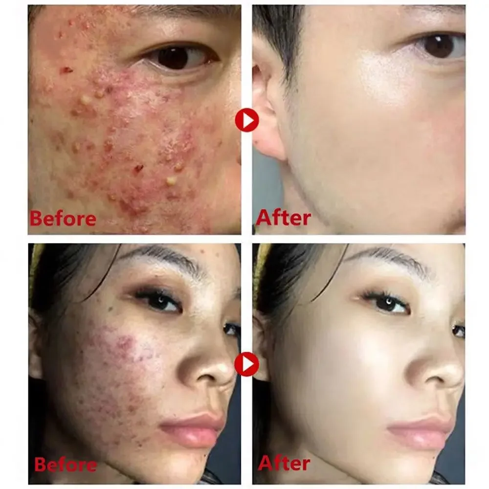 緑茶マスクスティック除去にきびにきびディープクレンジング浄化 - Green Tea Cleansing Clay Mask のレビューと価格