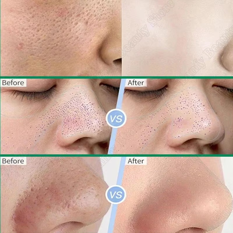サリチル酸毛穴クリアクリーム毛穴縮小黒ずみ除去ニキビ除去美白 - Salicylic Acid Blackhead Remover のレビューと価格